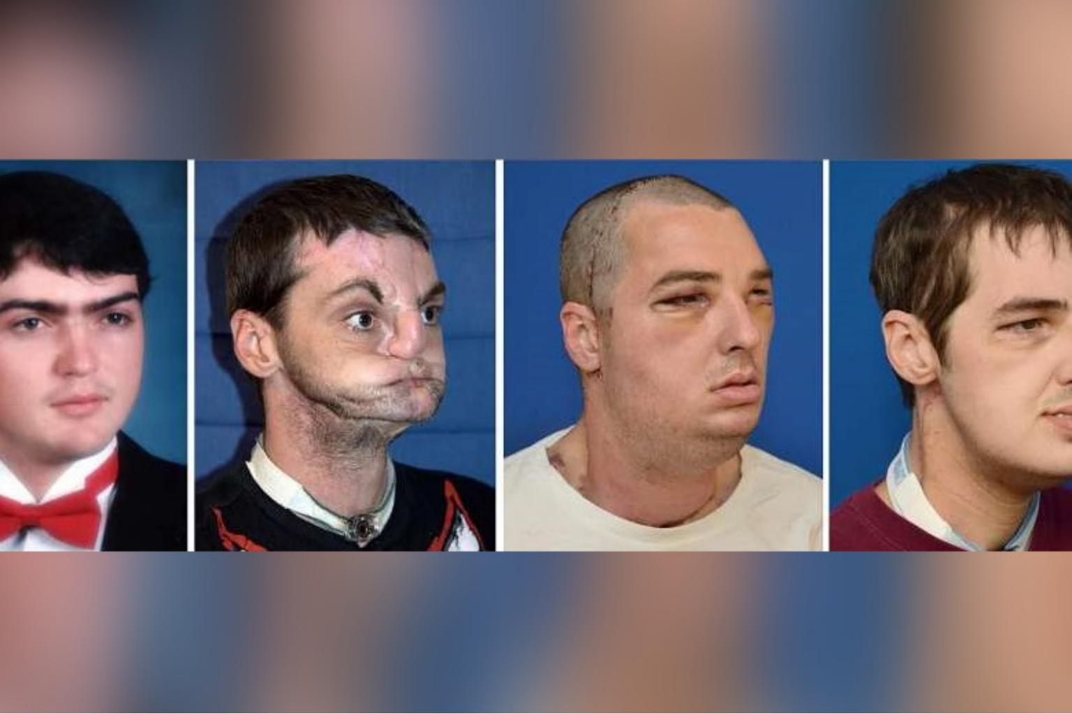 First US recipient of partial face transplant dies: Other cases of face transplants