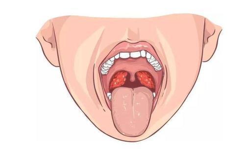 不知道嗓子的结构 嗓子疼可以这样分辨是咽喉炎还是扁桃体炎 Nestia