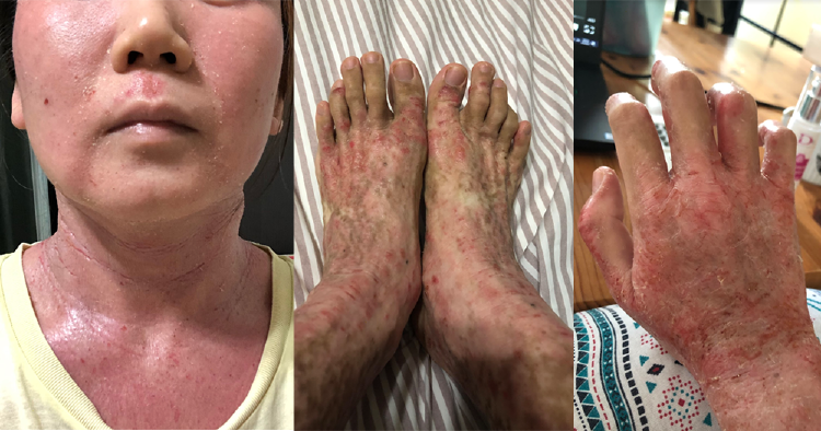 26 Year Old S Porean Woman Living With Rare Skin Condition I Thought It Was Severe Eczema Nestia