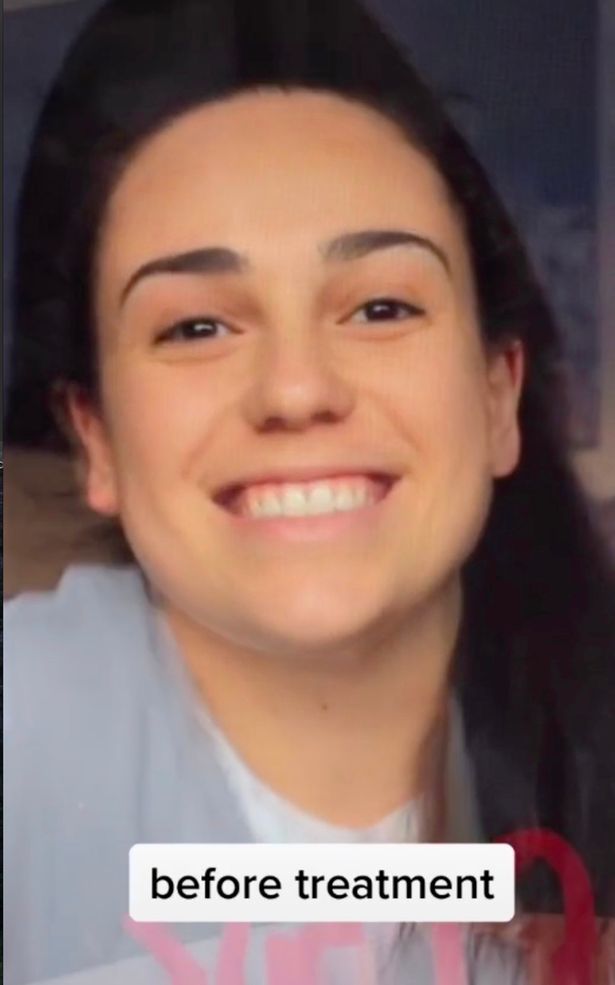 Teen mocked for looking like Buzz Lightyear after chin surgery unveils new look