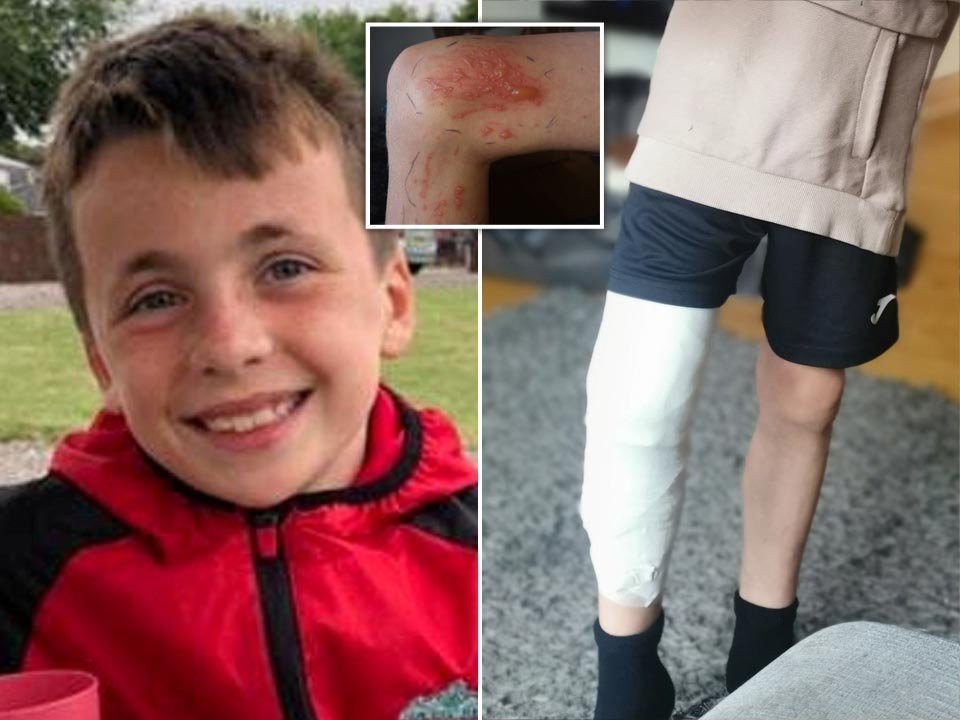 Mum issues warning after son receives third-degree burns from hogweed – dubbed Britain’s most dangerous plant