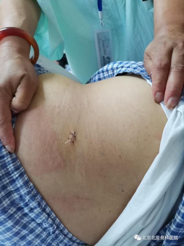 22岁女孩巨大间盘突出，嵴柱科椎间孔镜微创手术小创口精准治疗