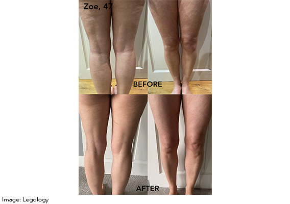 What happened when 5 women followed this 8-week anti-cellulite plan