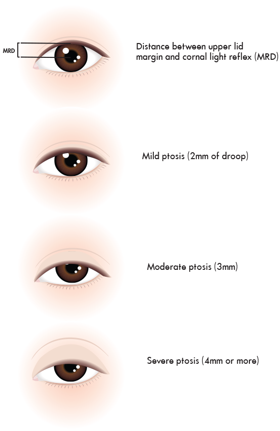 Ptosis surgery in Singapore: How to correct droopy eyelids & the clinics to visit