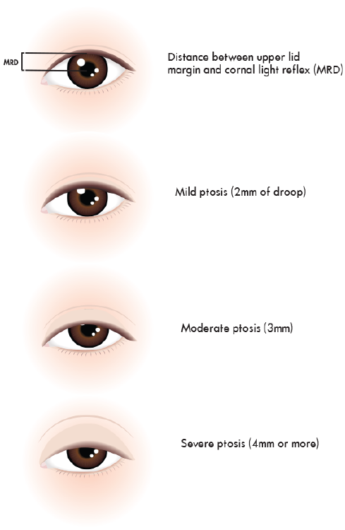 Ptosis Surgery In Singapore How To Correct Droopy Eyelids