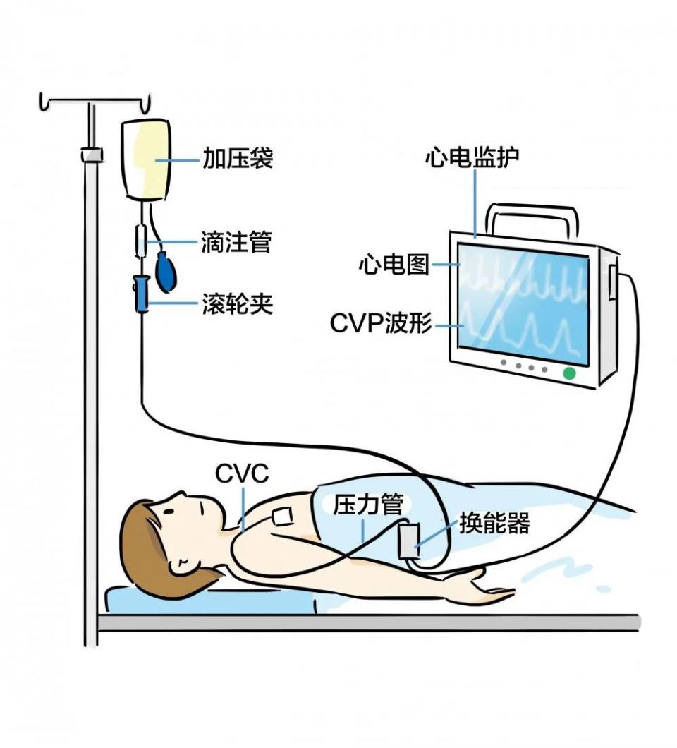 中心静脉压