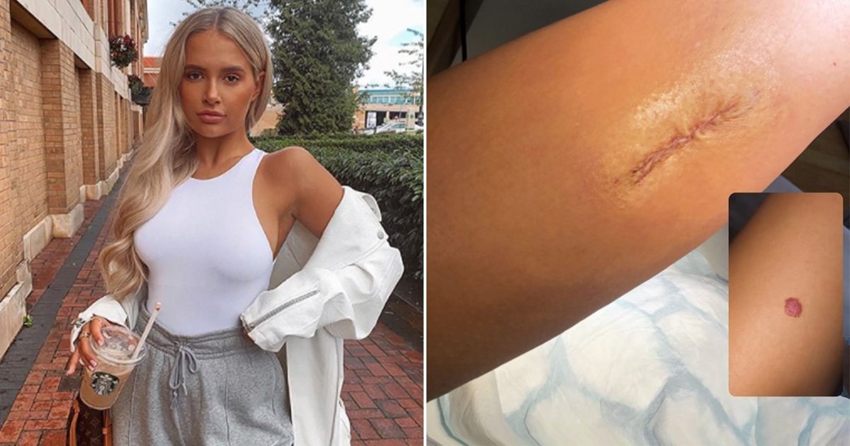 Molly-Mae Hague shares photo of grim scar as she gets mole removed after warning fans about cancer
