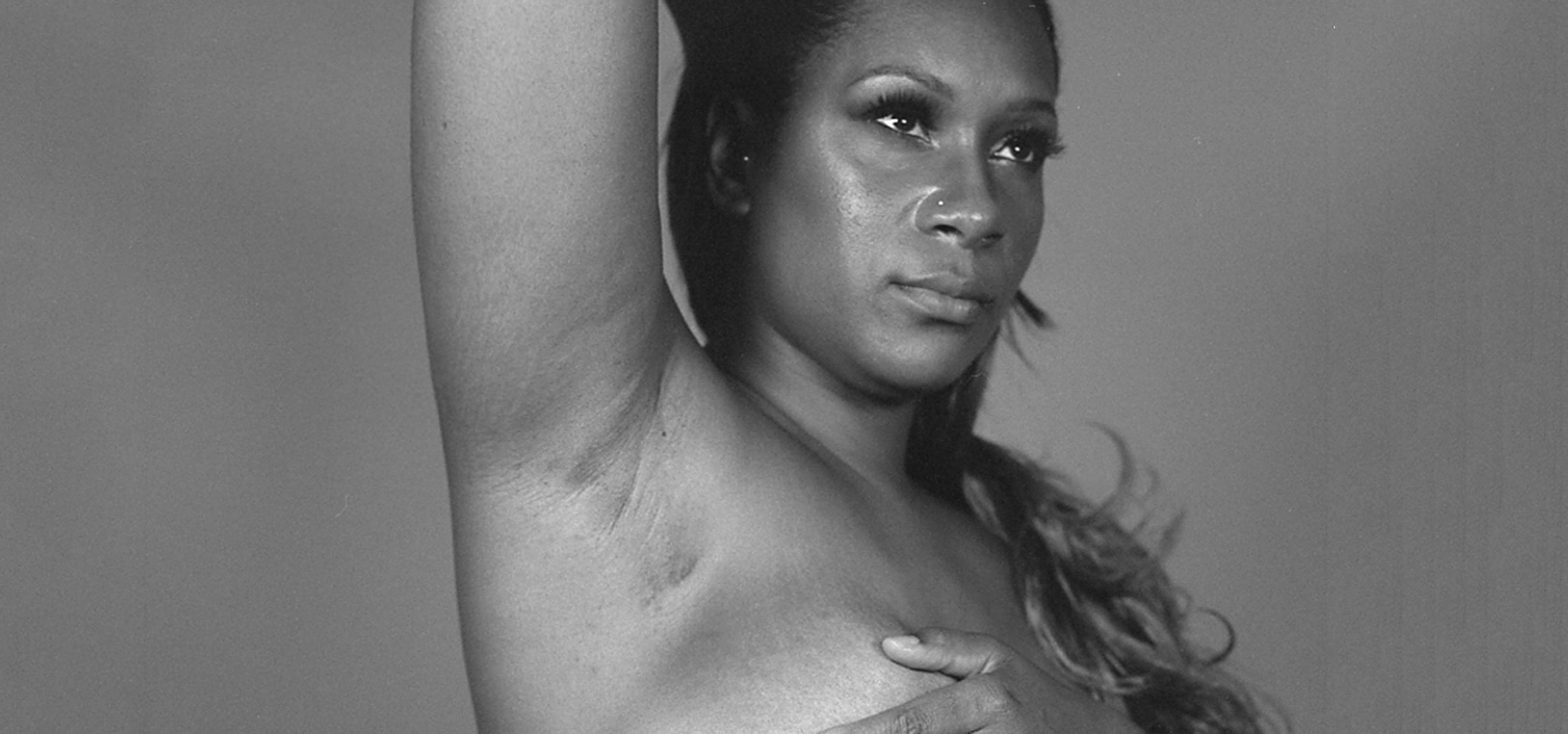 Black women with cancer are treated differently to white women. Fact. Let's change that...