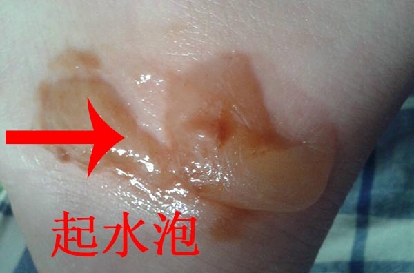 糖尿病下肢起水泡常见的原因不得不知道