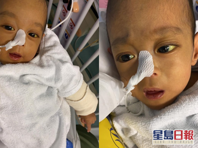 25周早产婴信信白血球上升或因细菌感染 急需换肝续命