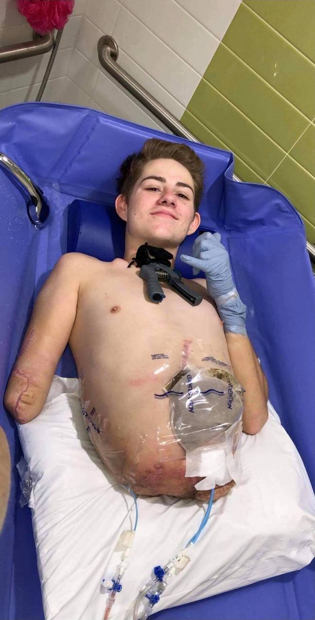 Teenager Chooses To Amputate Bottom Half Of Body To Save His Life