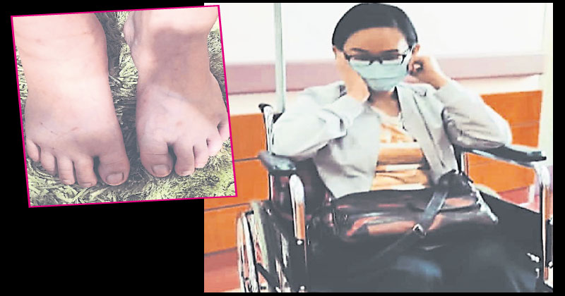 双脚麻痹浮肿 何芸妮入院治疗