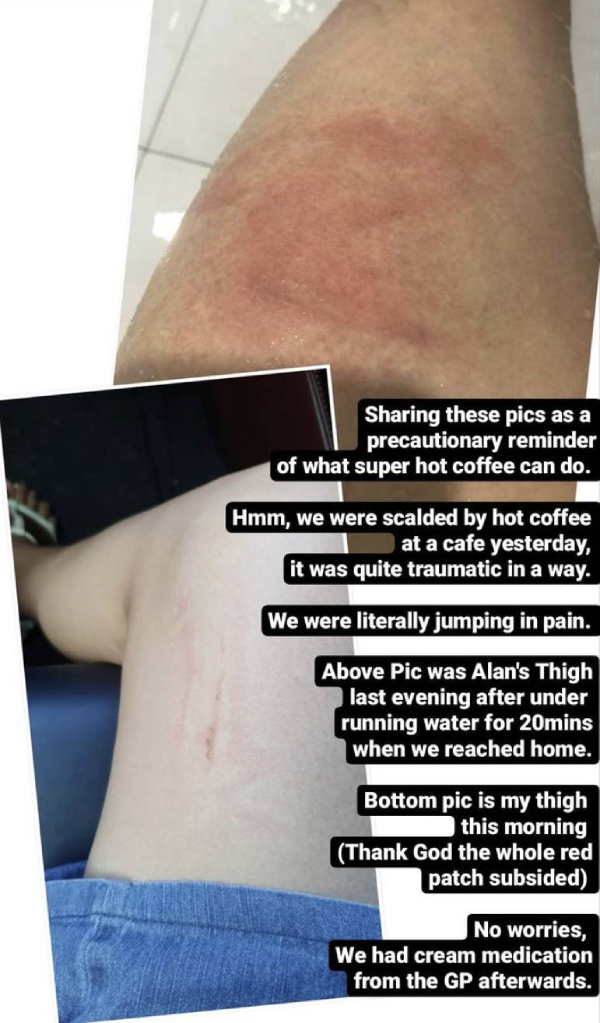 'Quite traumatic': Priscelia Chan and Alan Tern scalded by hot coffee at cafe