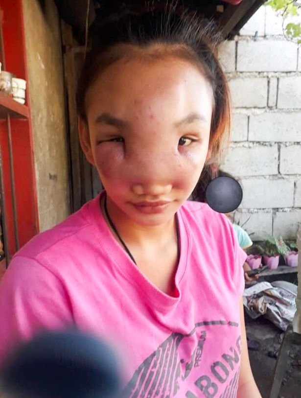 Girl, 17, blinded by mystery illness sparked from squeezing 'harmless' nose spot