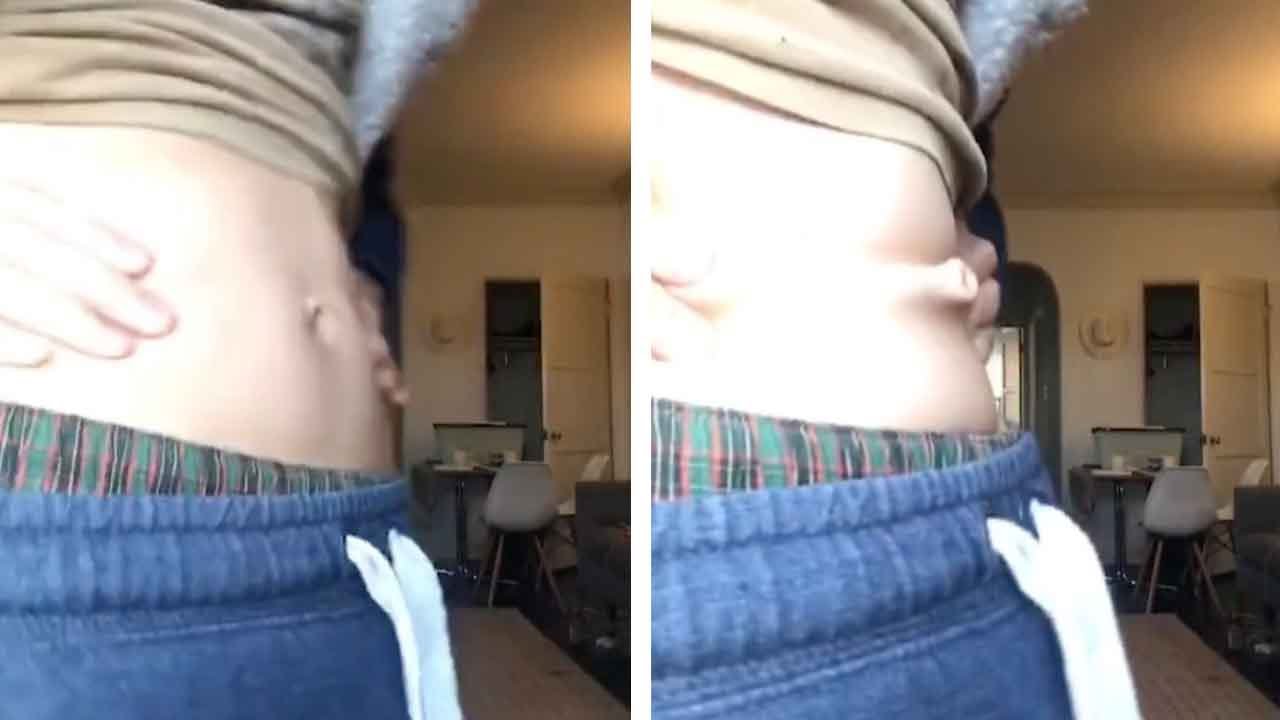 Man Has Bizarre Prominent Belly