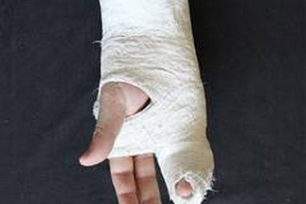 Speeding up bone implant recover with breakthrough discover