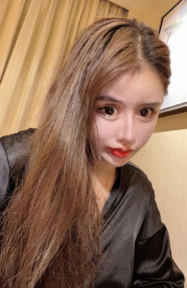 16岁网红整容逾百次 现记忆衰退等后遗症