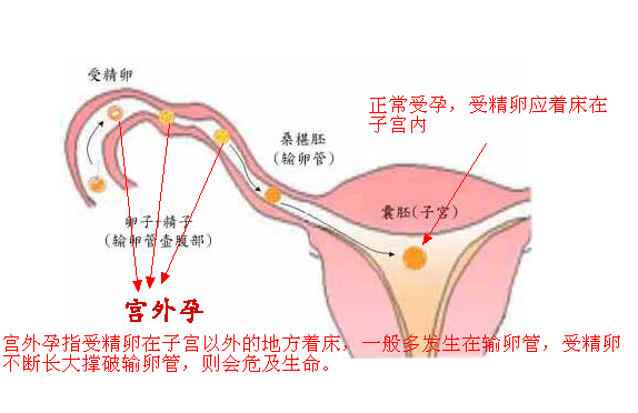 可怕 女子妊娠25周不自知 胎儿竟然在子宫外 安家 Nestia