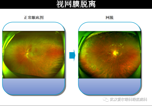 关于视网膜脱落，再不知道就晚了