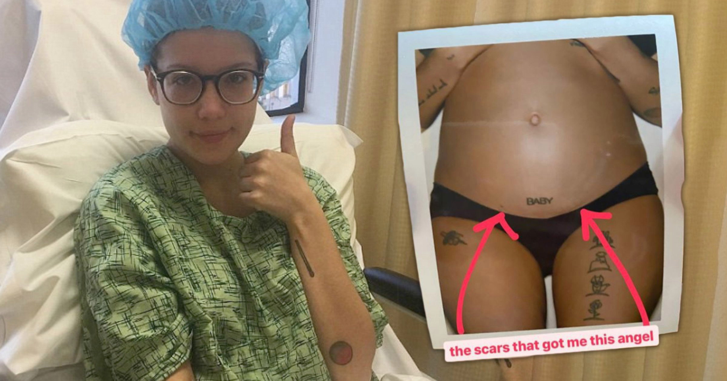 Pregnant Halsey shows off the ‘scars that got me this angel’ after endometriosis struggle