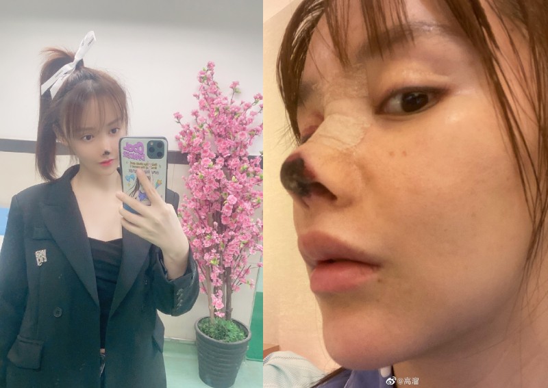 Chinese actress makes malpractice claims against hospital after suffering necrosis of the nose, authorities investigate