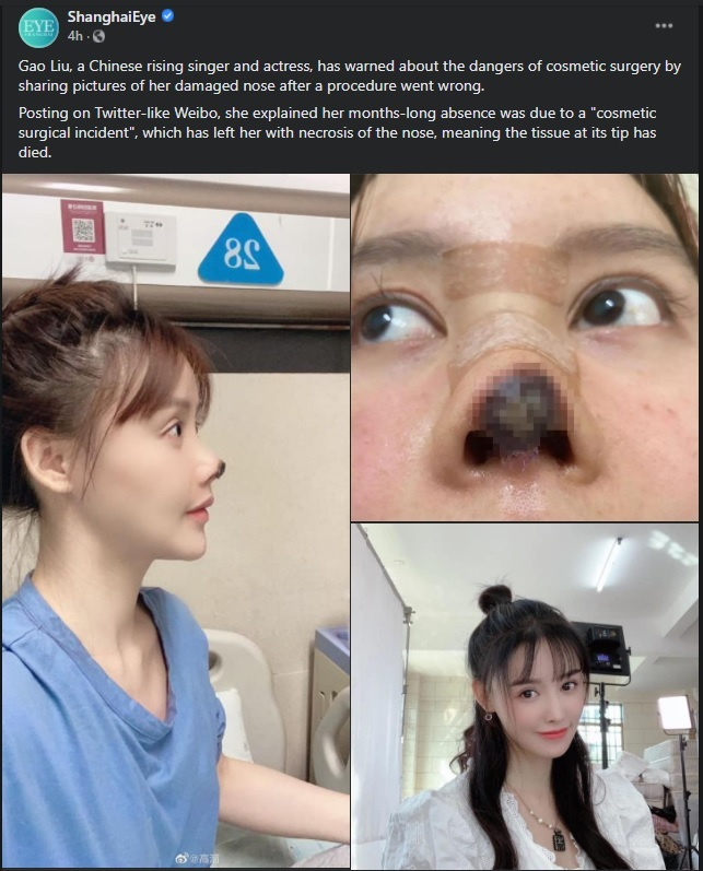 Chinese Actress Gao Liu Shares Horrific Images of Unsuccessful Nose Surgery