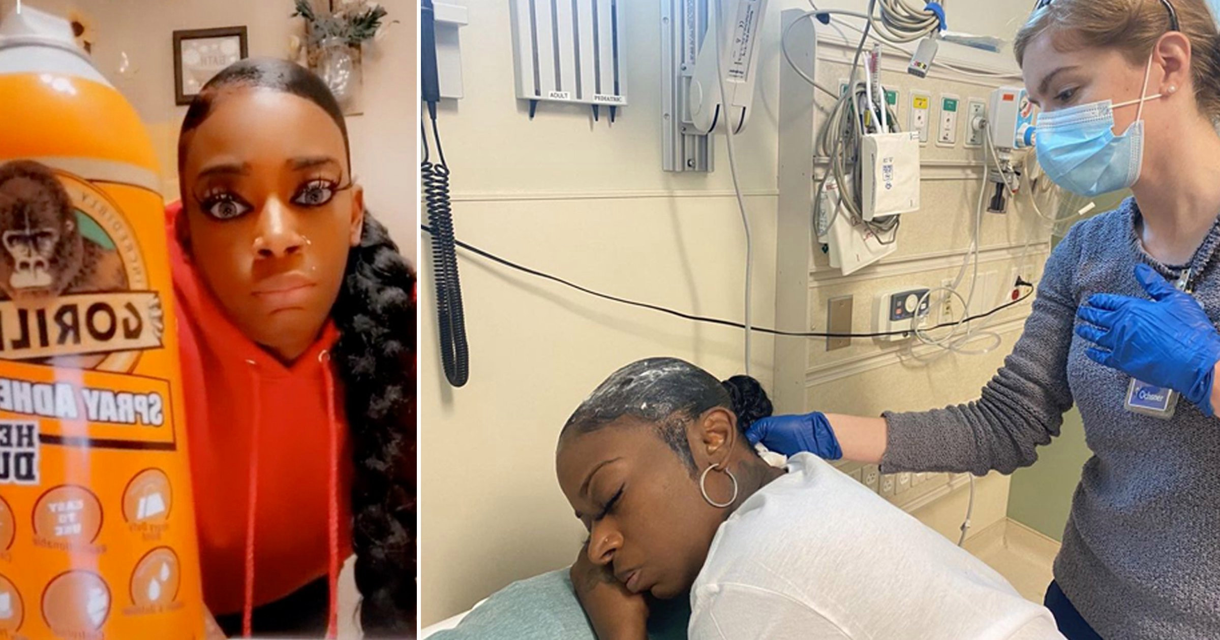 Woman has hospital treatment after styling hair with Gorilla Glue
