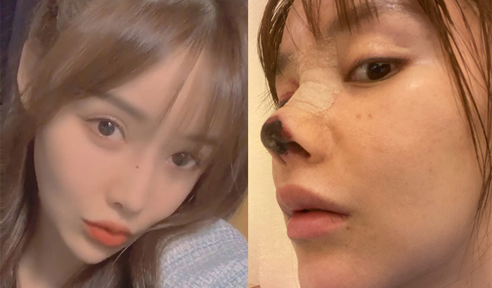 Chinese actress shared gory image of her botched nose job, igniting discussion on surgery regulations