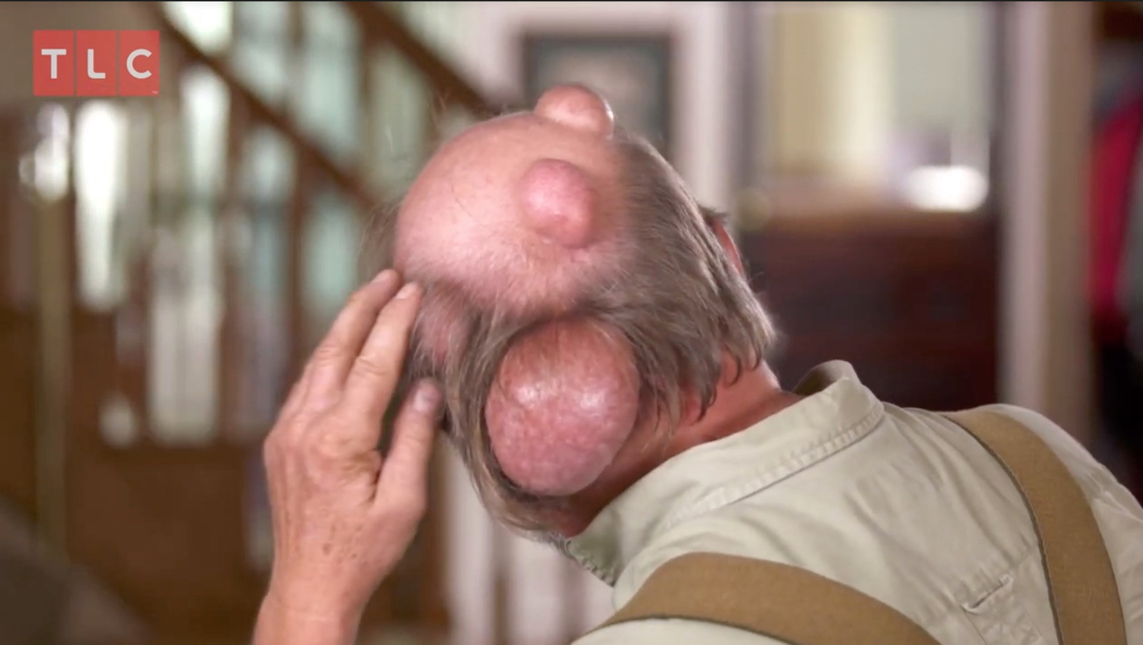 Dr Pimple Popper slices open 30-year-old balloon cyst as rusty brown liquid ‘like honey mustard’ oozes out