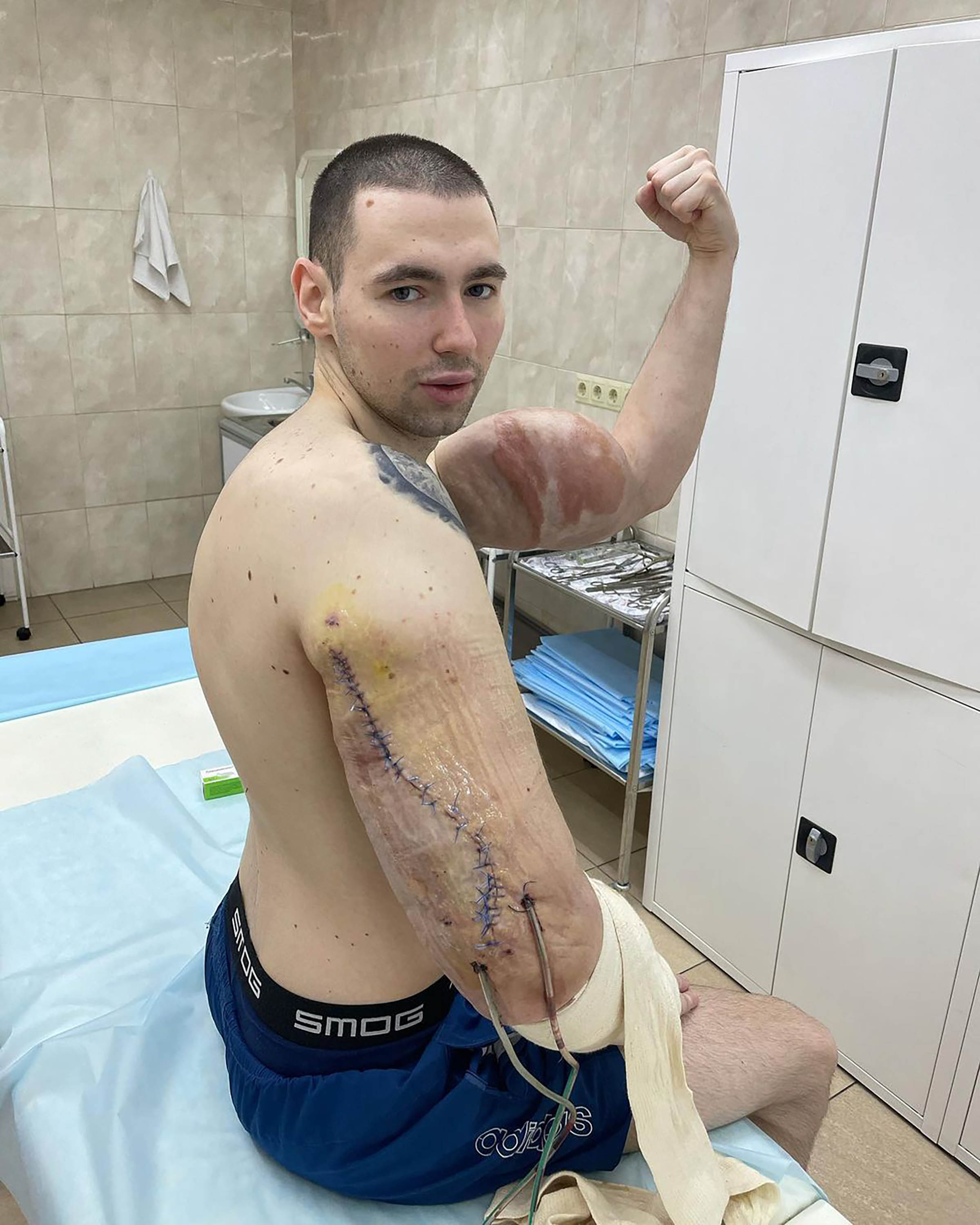 'Russian Popeye' Undergoes Surgery To Remove Hardened Jelly From Fake Muscles 