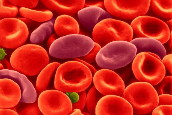Sickle Cell Treatment Not Linked to Cancer, Researchers Say