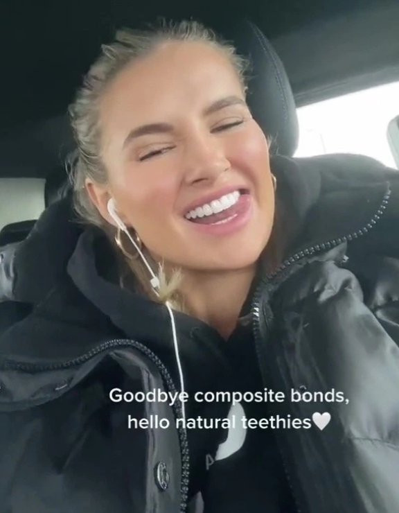 Molly-Mae Hague reveals real teeth after having veneers removed as she continues reversing cosmetic procedures