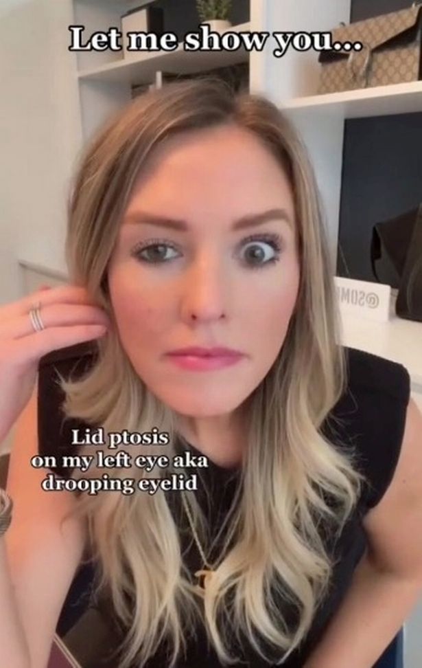 Botched Botox injection leaves TikTok star with eyelid that 'droops like crazy'