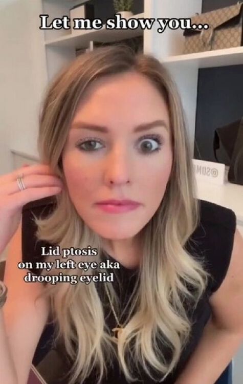 Botched Botox Injection Leaves Tiktok Star With Eyelid That Droops Botched Botox Injection Leaves Tiktok Star With Eyelid That Droops