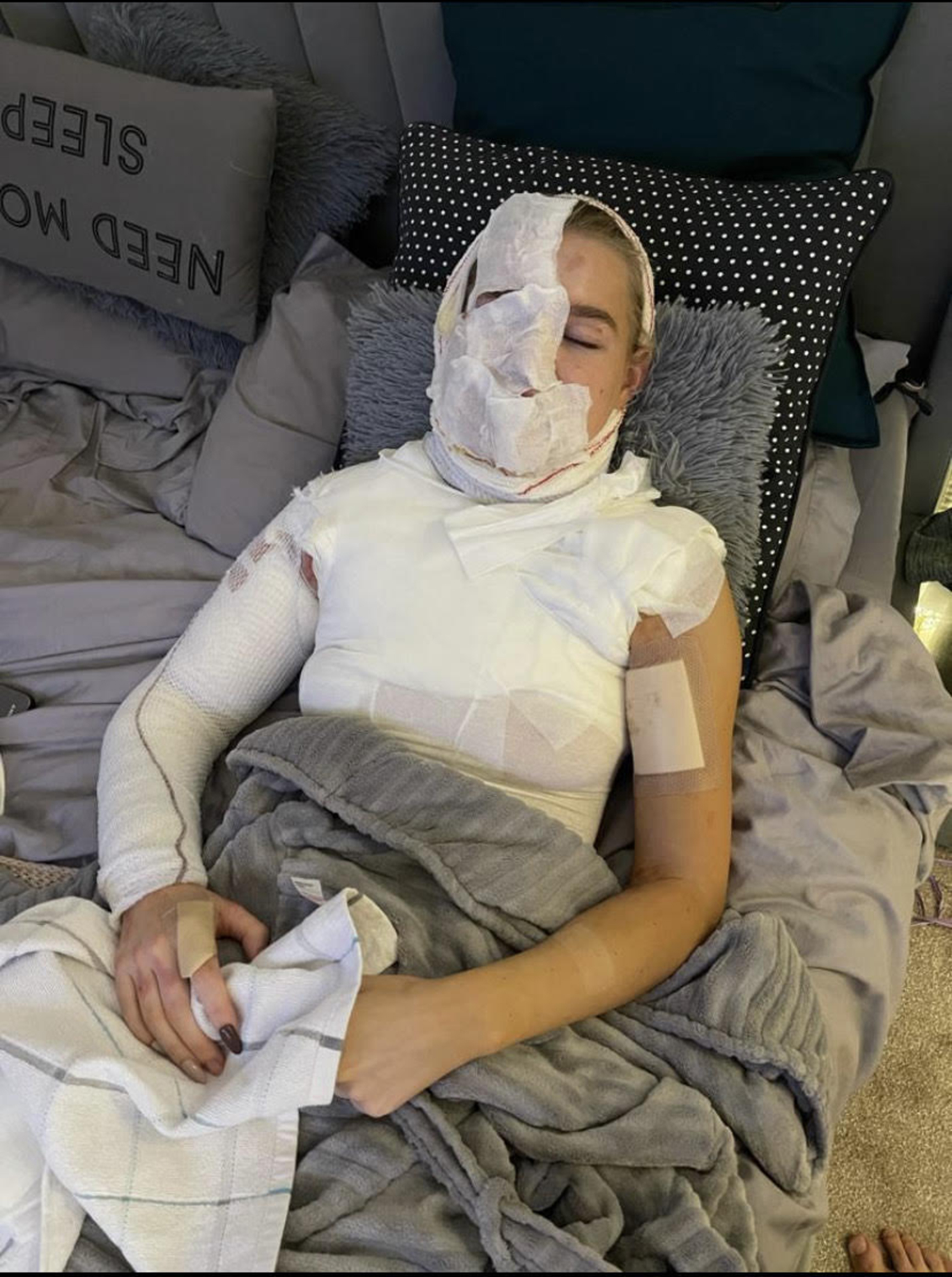 AJ Pritchard's Girlfriend Abbie Quinnen Pictured For First Time After Suffering Third Degree Burns