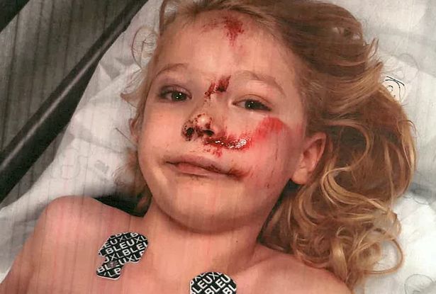 Boy, 6, hit by teen on scooter suffers fractured skull and is 'scared of his reflection'