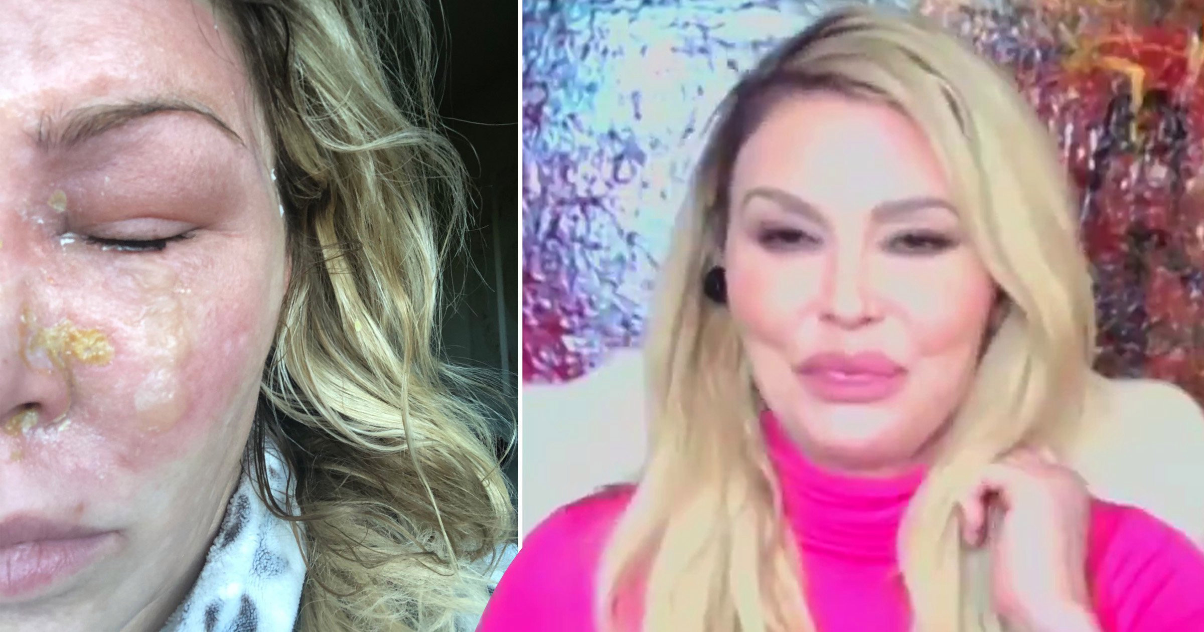 RHOBH star Brandi Glanville reveals second-degree facial burns as she hits back at plastic surgery claims