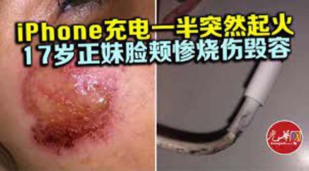 iPhone充电一半突然起火　17岁正妹脸颊惨烧伤毁容
