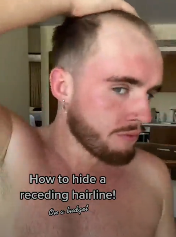 TikToker Shows His Hack To Hide Receding Hairline