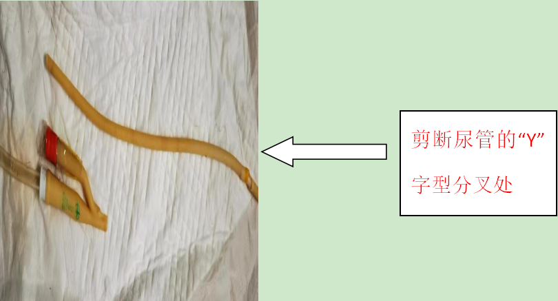 气囊导尿管中水去哪儿了？拔管困难怎么办？看看下面的内容~