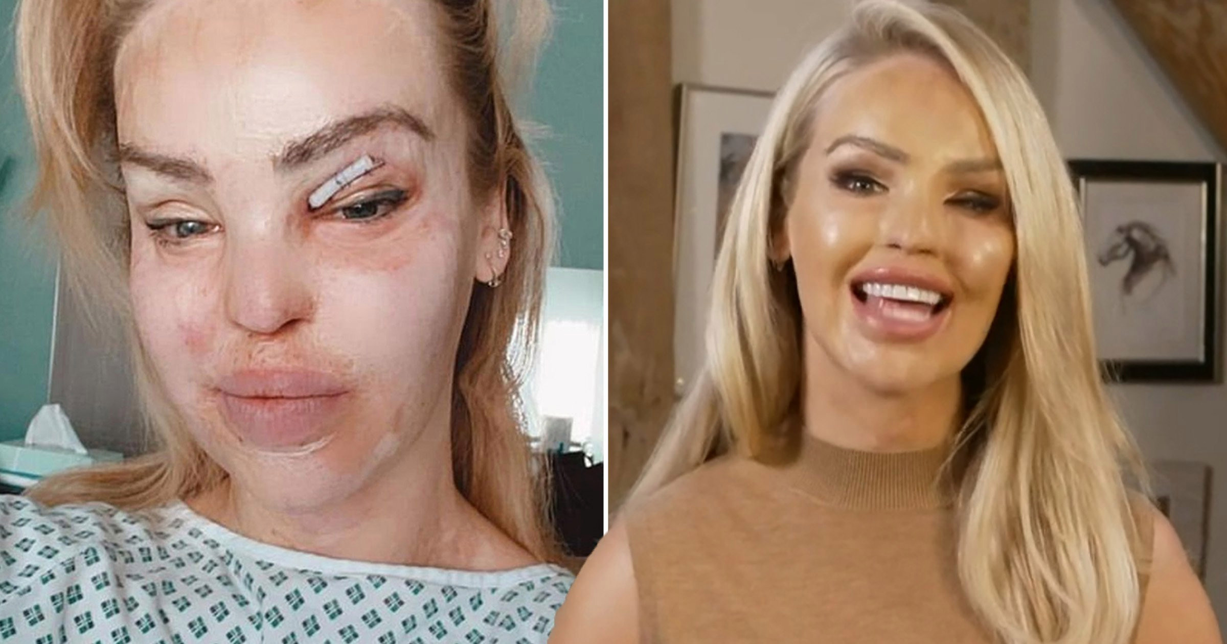 Katie Piper reveals bandaged eye in hospital as she recovers from surgery on acid attack injury