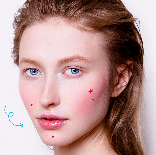 Papulopustular Rosacea: What It Is, What Causes It, and How to Treat It