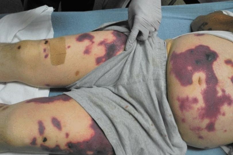 Graphic Images Show How Cocaine Laced With Chemicals Can Rot Skin And Genitals