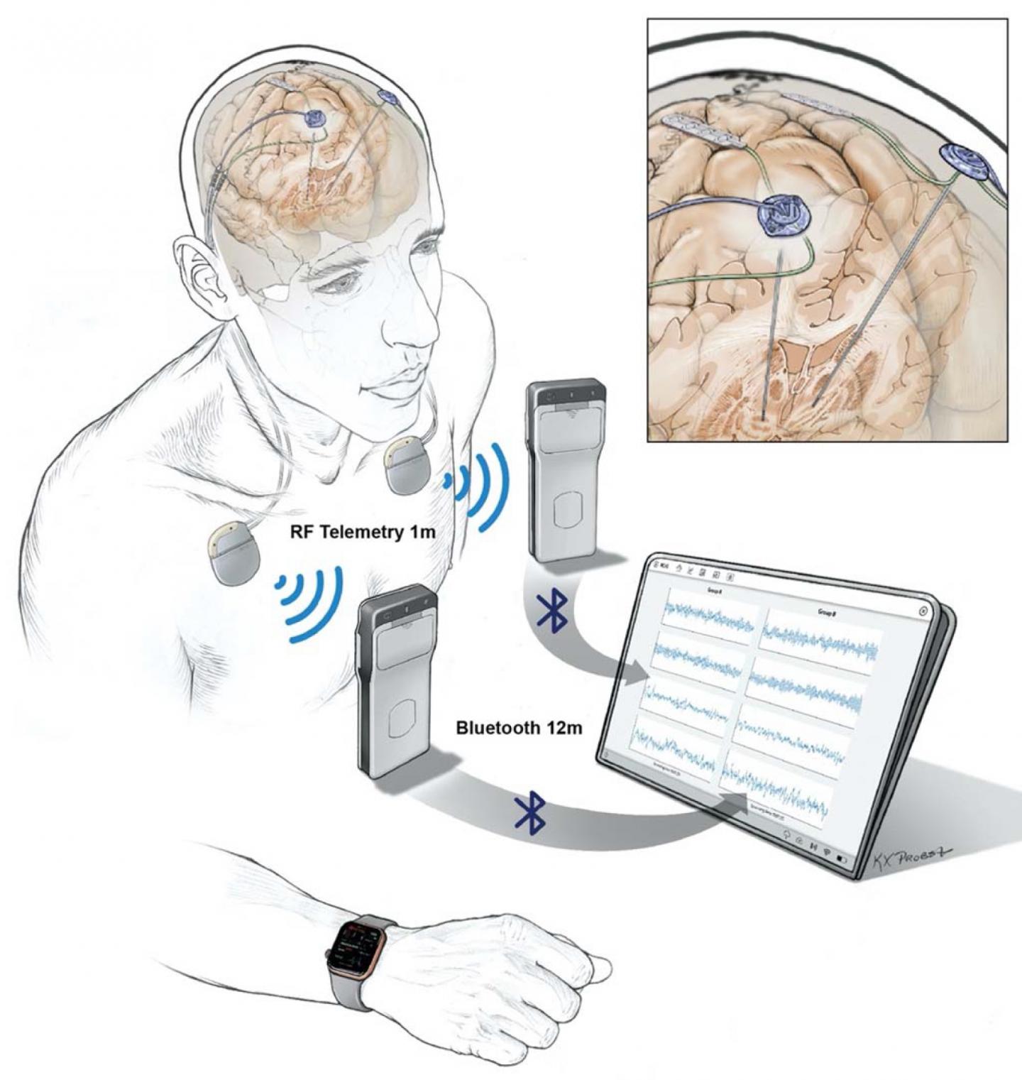 Researchers wirelessly record human brain activity during normal life activities