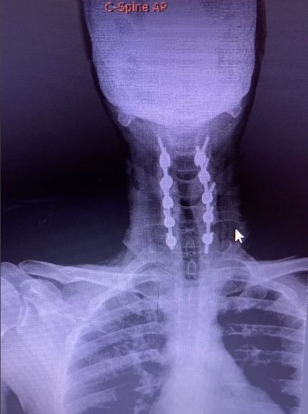 Paralysed man makes miracle recovery - so he can kick his friend in the balls