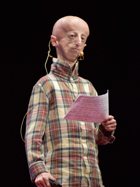 'Real-Life Benjamin Button' Has Looked Old Since He Was A Child