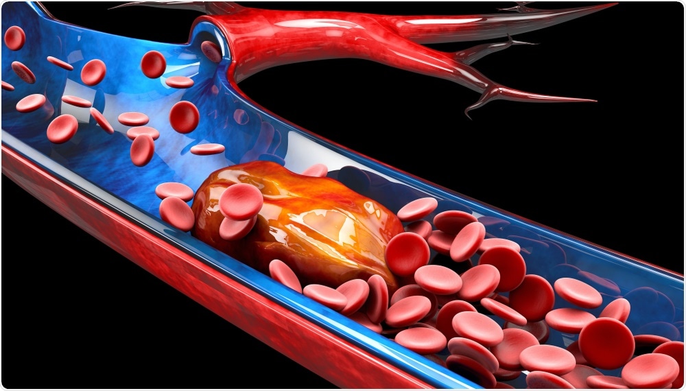 A study reports the first case of an upper extremity deep vein thrombosis (DVT) recurrence due to COVID-19 infection