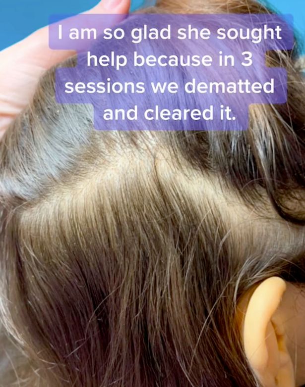 Professional headlice remover shares the worst nits she's ever treated