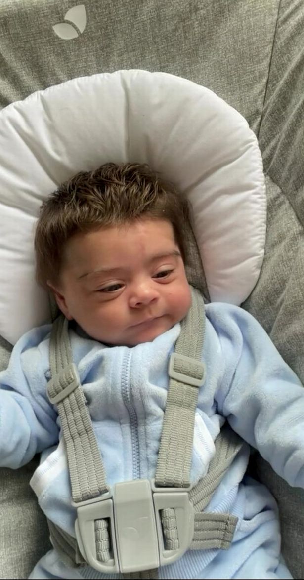 Medicine side effect gives premature newborn baby luscious full head of hair