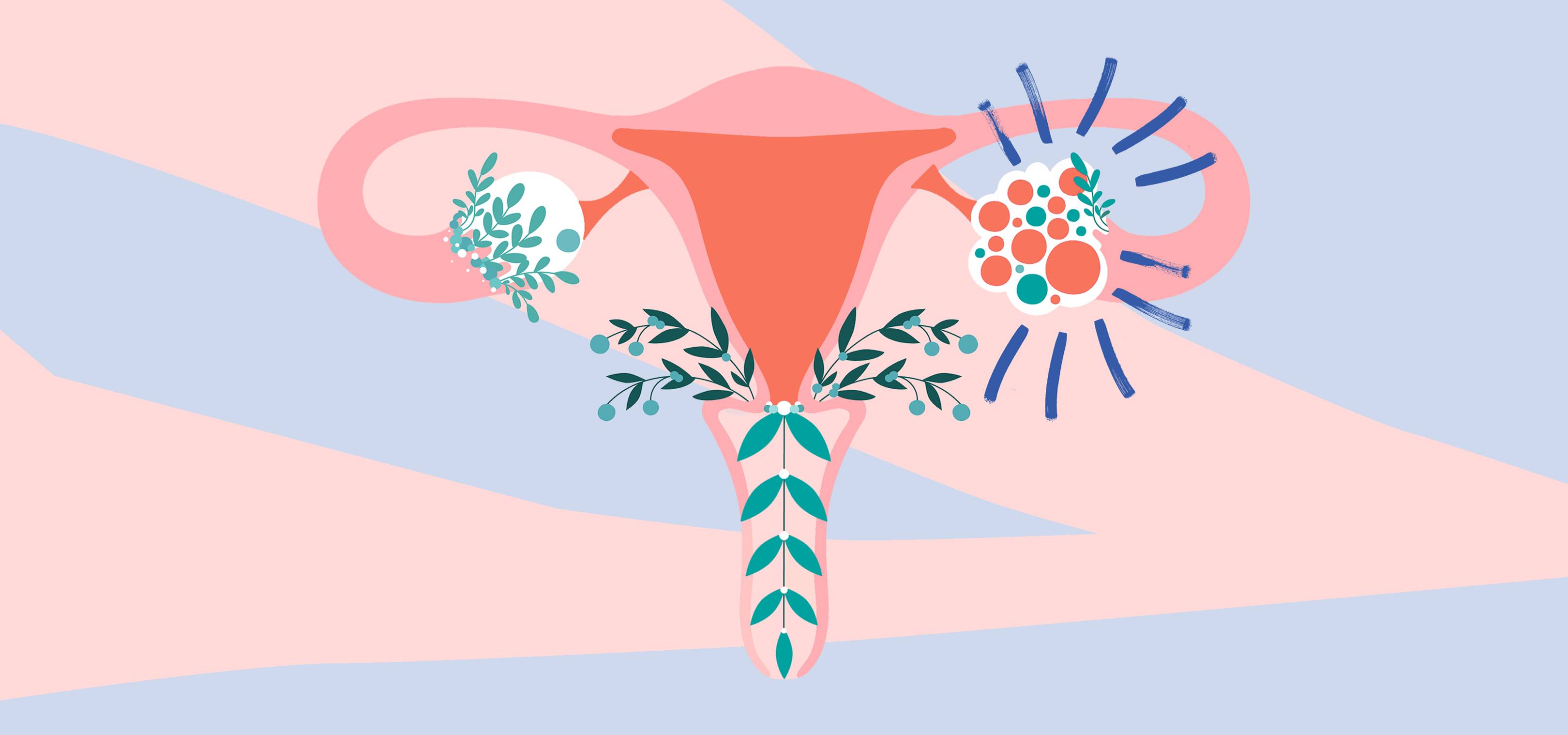 Everything you need to know about polycystic ovary syndrome, including symptoms, treatment, and it what it's really like to live with the under-discussed condition